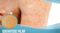 Queratose Pilar