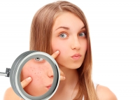 Pele com acne necessita de cuidados especiais