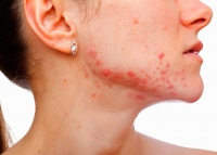 Como Diminuir as Cicatrizes Deixadas pela Acne - O Tormento dos Adolescentes