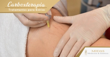 Carboxiterapia - Tratamento para Estrias