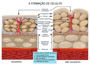 Melhores Tratamentos Estéticos para Acabar com a Celulite