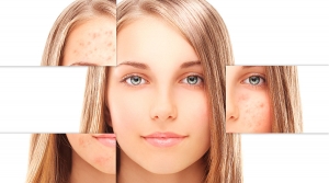 Qual seu tipo de Acne? Saiba como tratar cada um.