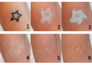 Tatuagens dicas para cobrir ou remover