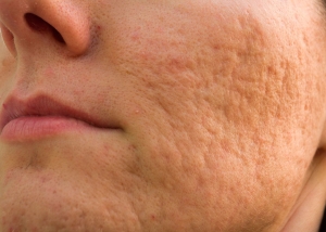 Acne: os melhores tratamentos você  encontra aqui