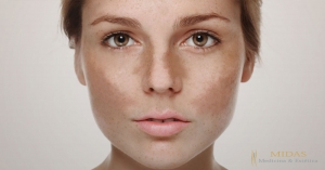 Melasma - Como combater?