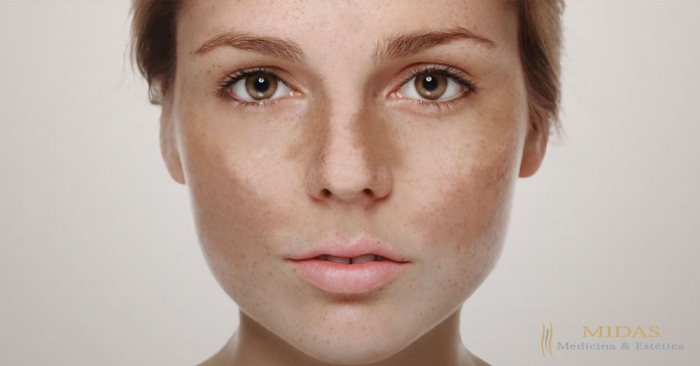 Melasma - Como combater?