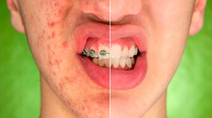 Sua pele vive cheia de acne? Saiba o que fazer para se livrar desse problema!.