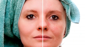 Melasma: saiba como eliminar essas manchas da pele!