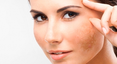 Tudo sobre Melasma