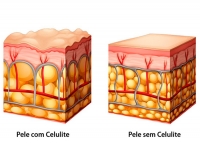 Como acabar com a celulite?